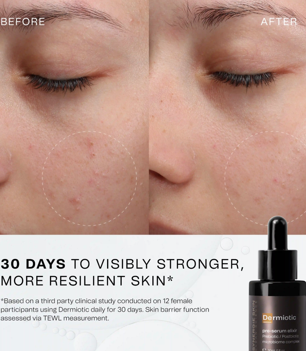 Synergie Skin Dermiotic before and after - 30 days to visibly stronger more resilient skin probiotic serum Australia