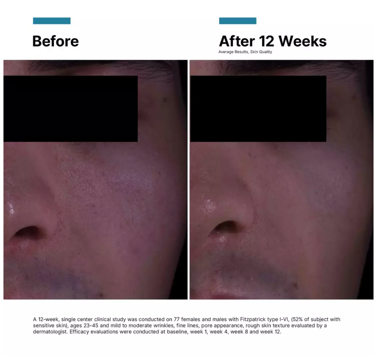 SkinCeuticals P-TIOX Anti-Wrinkle Cream before and after 12 weeks clinical study results showing improved skin texture and pore appearance