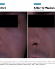 SkinCeuticals P-TIOX Anti-Wrinkle Cream before and after 12 weeks clinical study results showing improved skin texture and pore appearance